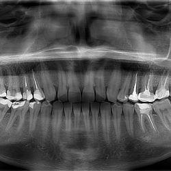 Panoramic X-rays of teeth